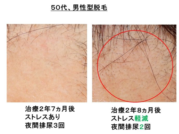 円形脱毛症　病院